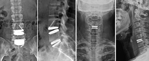 인공관절 치환술 이미지
